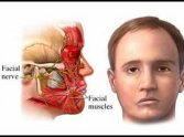 Tratamento da paralisia facial de Bell e a prevenção de sincinesias