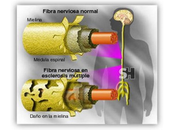 El daño a la mielina ocasiona un deterioro en la señalización entre los nervios