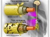 Efectos del ejercicio físico sobre la esclerosis múltiple