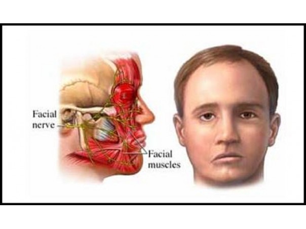 Ilustração do nervo e músculos faciais. Imagem retirada da Internet para melhor demonstração do nervo facial e sua anatomia.