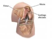 Ejercicio físico y condromalacia rotuliana